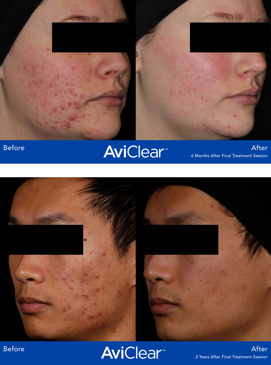 AviClear-Acne-2