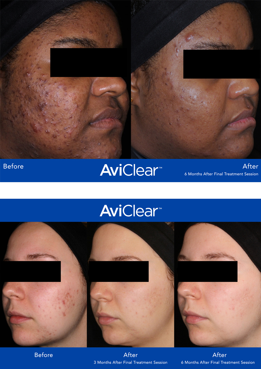 AviClear-Acne-3